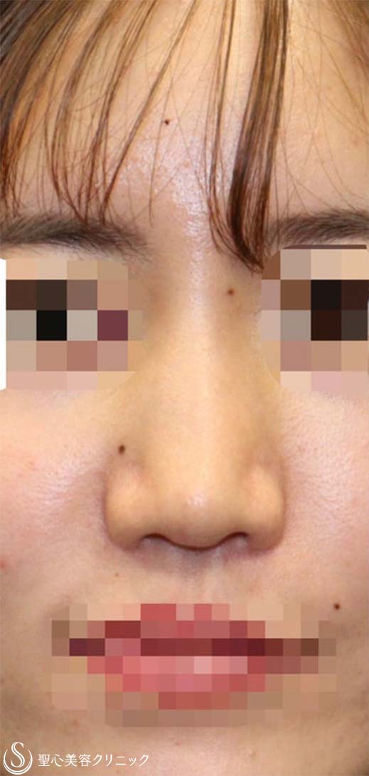 【20代女性・他院修正手術 美人鼻に】鼻中隔延長術(肋軟骨) + 鼻尖形成術(耳介軟骨)  + 鼻骨骨切り幅寄せ + プロテーゼ入替 (術後2週間) Before 