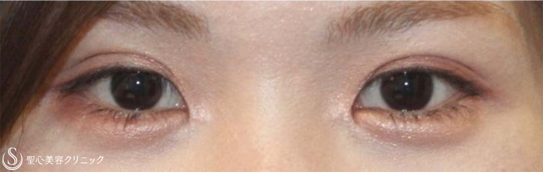【20代女性・より過ぎた目頭を綺麗に】蒙古襞形成（術後10ヶ月） After 