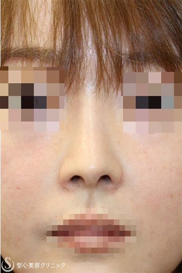 【30代女性・上下に長い鼻の穴＆アップノーズを改善】他院鼻修正(術後3ヶ月) Before 