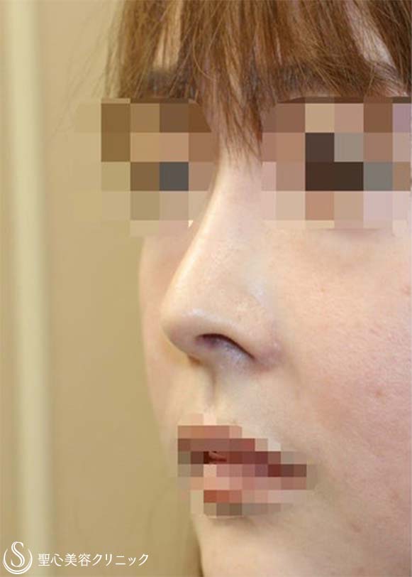 【30代女性・上下に長い鼻の穴＆アップノーズを改善】他院鼻修正(術後3ヶ月) Before 
