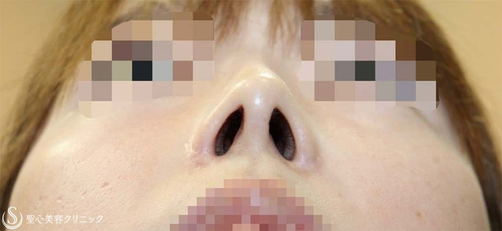 【30代女性・上下に長い鼻の穴＆アップノーズを改善】他院鼻修正(術後3ヶ月) Before 