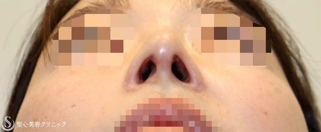 【30代女性・上下に長い鼻の穴＆アップノーズを改善】他院鼻修正(術後3ヶ月) After 