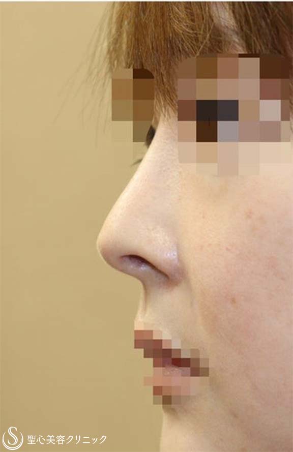 【30代女性・上下に長い鼻の穴＆アップノーズを改善】他院鼻修正(術後3ヶ月) Before 