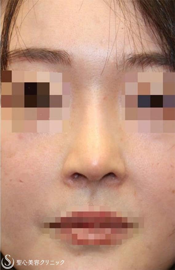 【30代女性・上下に長い鼻の穴＆アップノーズを改善】他院鼻修正(術後3ヶ月) After 