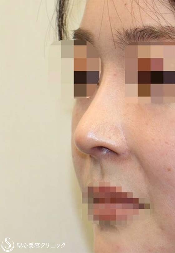 【30代女性・上下に長い鼻の穴＆アップノーズを改善】他院鼻修正(術後3ヶ月) After 