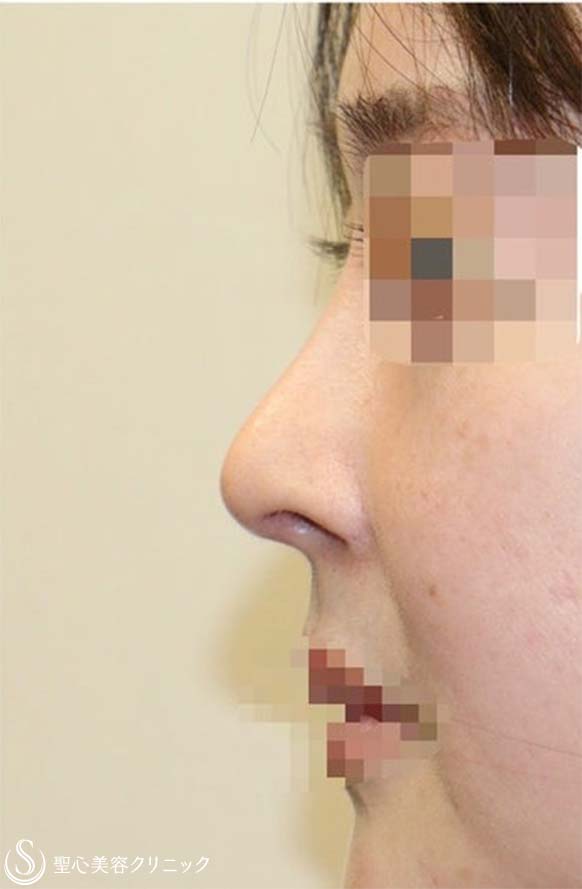 【30代女性・上下に長い鼻の穴＆アップノーズを改善】他院鼻修正(術後3ヶ月) After 
