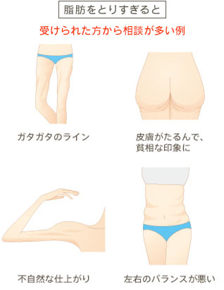 脂肪をとりすぎると 受けられた方から相談が多い例 ガタガタのライン 皮膚がたるんで、貧相な印象に 不自然な仕上がり 左右のバランスが悪い