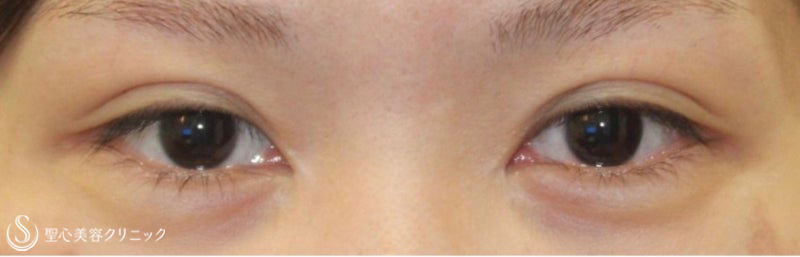 【20代女性・より過ぎた目頭を綺麗に】蒙古襞形成（術後10ヶ月） Before 