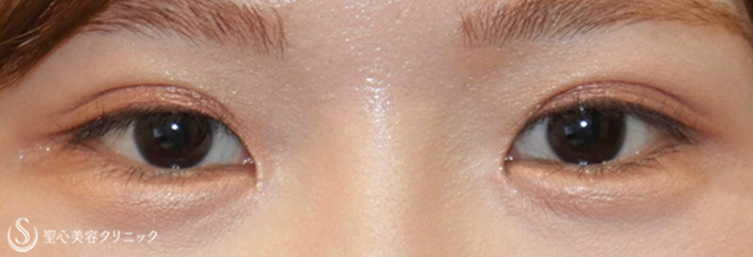 【20代女性・より過ぎた目頭を綺麗に】蒙古襞形成（術後10ヶ月） After 