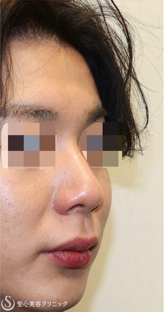 【20代男性・鼻先がスッキリしてイケメンに】鼻尖縮小術・鼻尖形成術（耳介軟骨移植）（術後1ヶ月） Before 