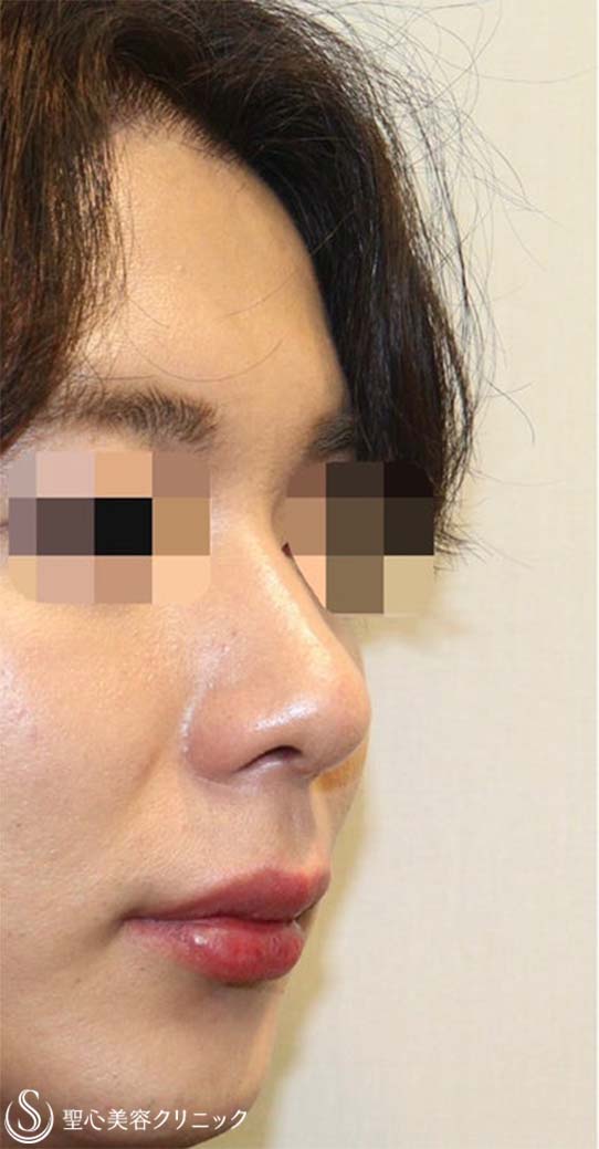 【20代男性・鼻先がスッキリしてイケメンに】鼻尖縮小術・鼻尖形成術（耳介軟骨移植）（術後1ヶ月） After 