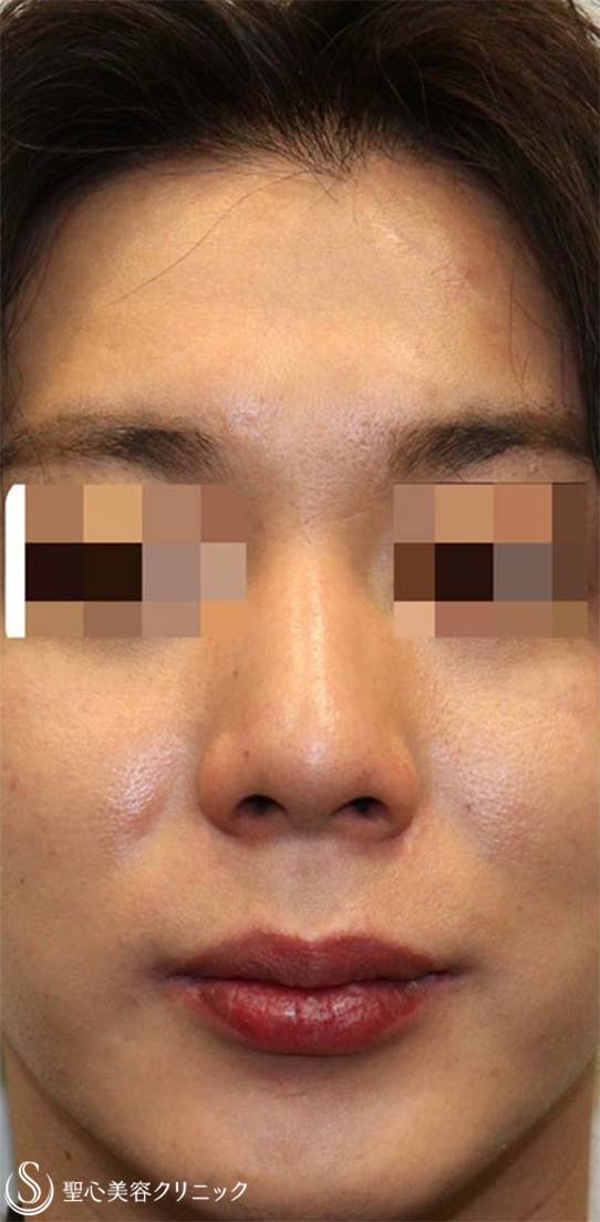 【20代男性・鼻先がスッキリしてイケメンに】鼻尖縮小術・鼻尖形成術（耳介軟骨移植）（術後1ヶ月） Before 