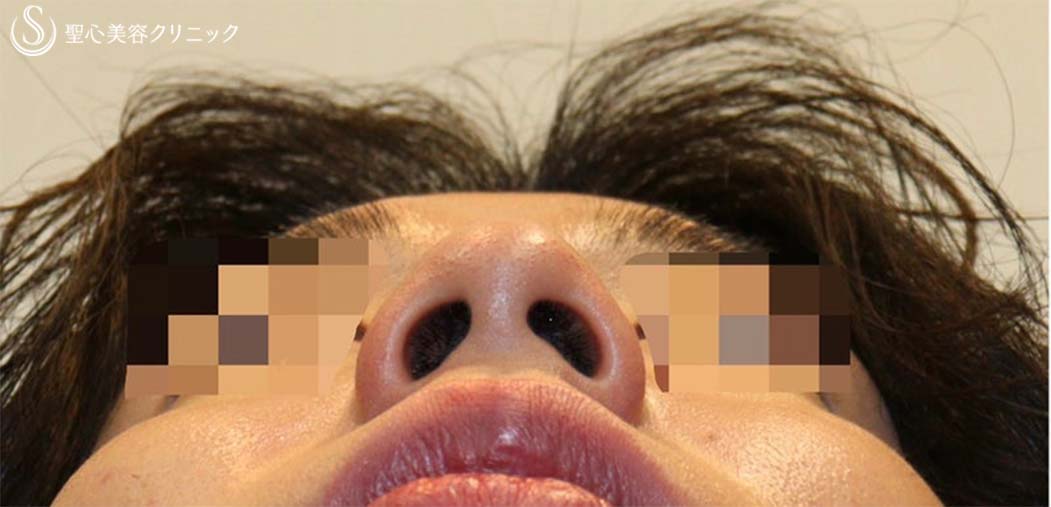 【20代男性・鼻先がスッキリしてイケメンに】鼻尖縮小術・鼻尖形成術（耳介軟骨移植）（術後1ヶ月） Before 