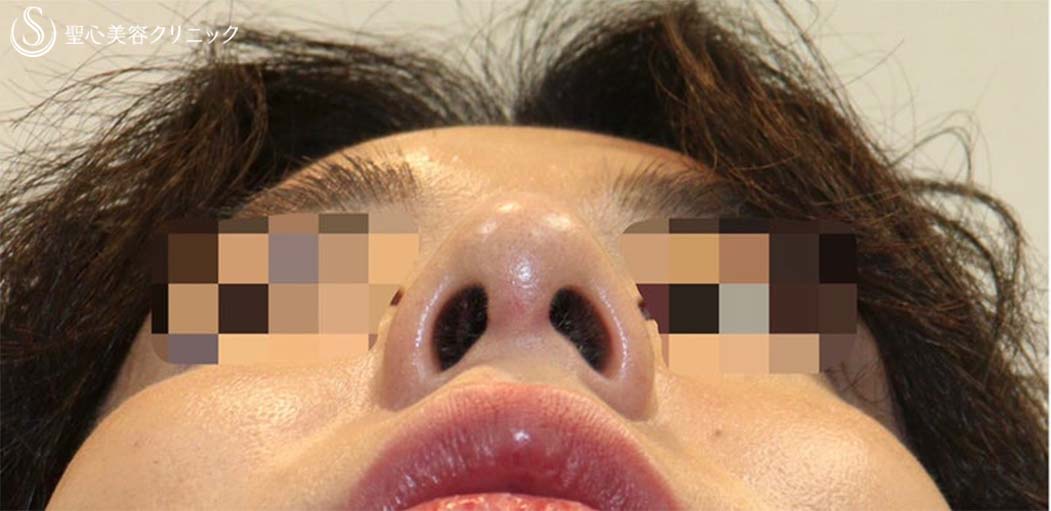 【20代男性・鼻先がスッキリしてイケメンに】鼻尖縮小術・鼻尖形成術（耳介軟骨移植）（術後1ヶ月） After 