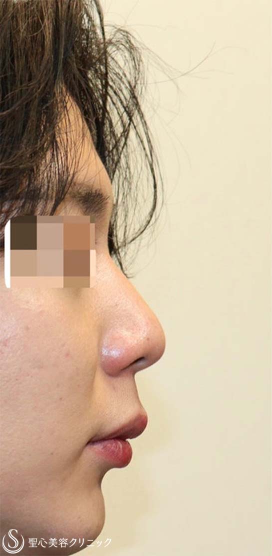 【20代男性・鼻先がスッキリしてイケメンに】鼻尖縮小術・鼻尖形成術（耳介軟骨移植）（術後1ヶ月） Before 