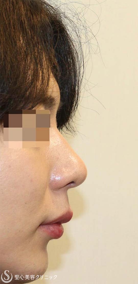 【20代男性・鼻先がスッキリしてイケメンに】鼻尖縮小術・鼻尖形成術（耳介軟骨移植）（術後1ヶ月） After 