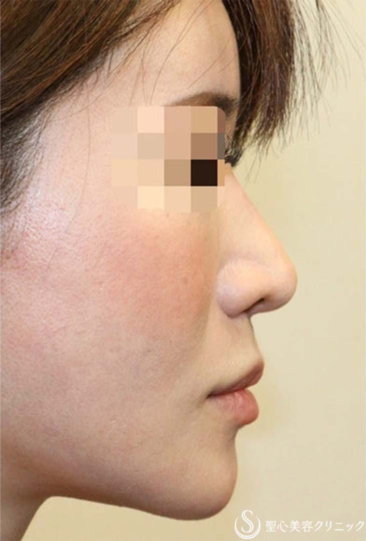 【30代女性・鼻筋がやや反った綺麗なお鼻に】他院鼻修正:鼻中隔延長術(肋軟骨)+鼻尖形成(耳介軟骨は再利用)+鼻根プロテーゼ入れ替え(術後1 ...