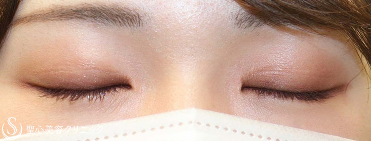 【20代女性・自然で綺麗な平行型二重に】二重全切開 ＋ 目上切開（術後２年） After 