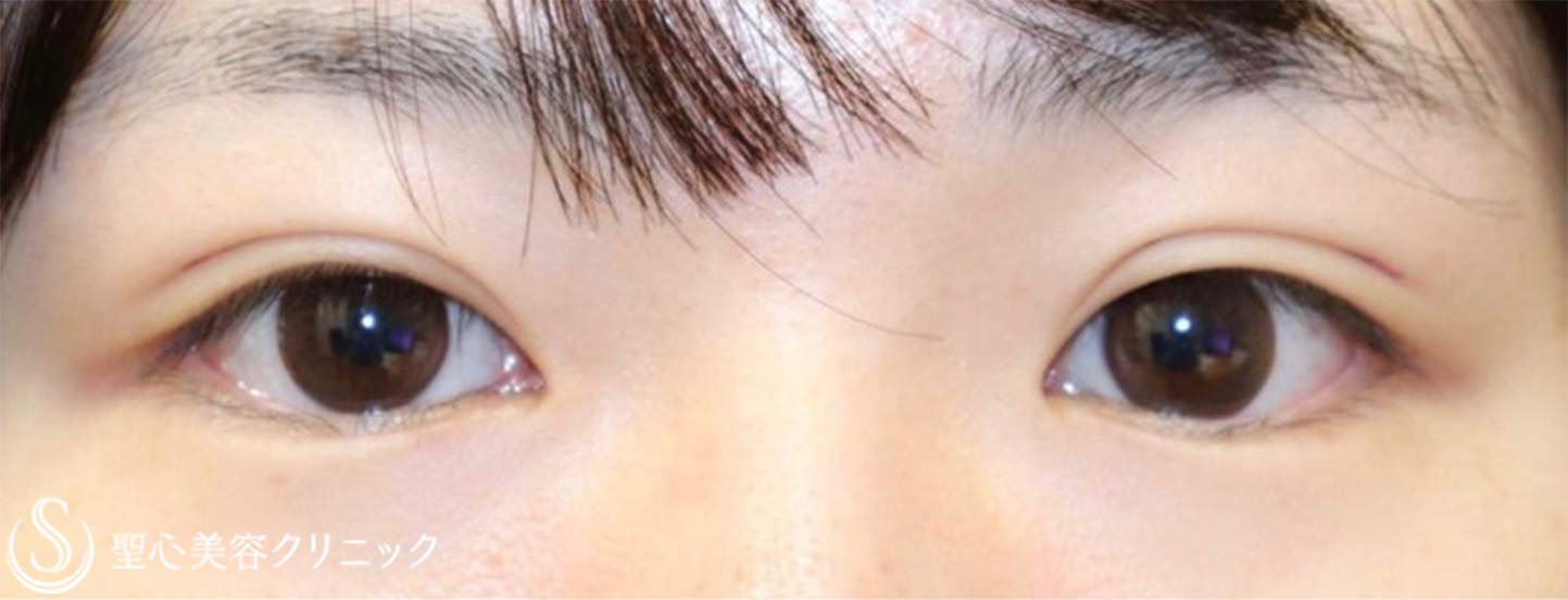 【20代女性・自然で綺麗な平行型二重に】二重全切開 ＋ 目上切開（術後２年） Before 
