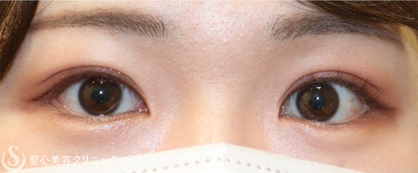 【20代女性・自然で綺麗な平行型二重に】二重全切開 ＋ 目上切開（術後２年） After 