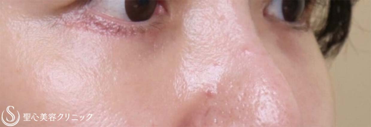 【40代女性・目の下のクマ・シワ・タルミ・膨らみ・凹みをスッキリ】ハムラ法（術後1ヶ月） After 