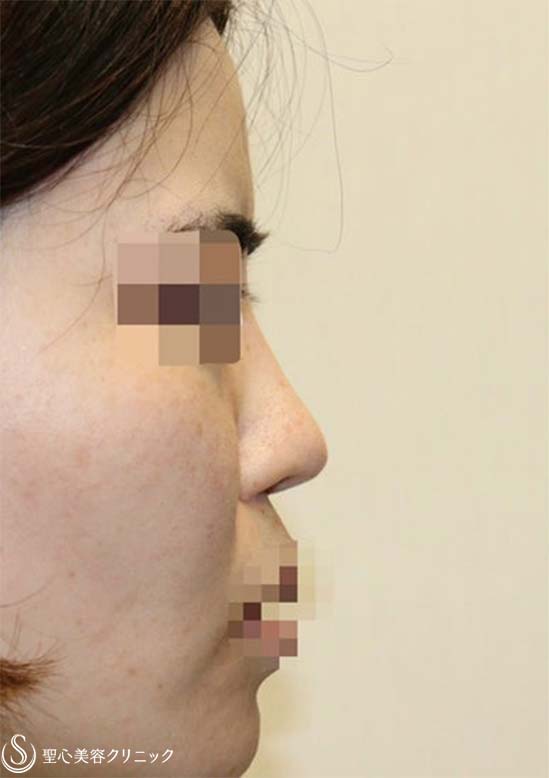 【30代女性・鼻柱の曲がりを修正】他院鼻修正：鼻中隔延長術（肋軟骨）＋鼻尖形成（耳介軟骨）＋鼻根プロテーゼ入替（術後４ヶ月） Before 