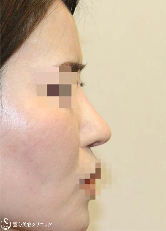 【30代女性・鼻柱の曲がりを修正】他院鼻修正：鼻中隔延長術（肋軟骨）＋鼻尖形成（耳介軟骨）＋鼻根プロテーゼ入替（術後４ヶ月） After 