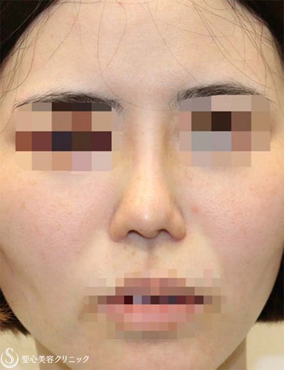 【30代女性・鼻柱の曲がりを修正】他院鼻修正：鼻中隔延長術（肋軟骨）＋鼻尖形成（耳介軟骨）＋鼻根プロテーゼ入替（術後４ヶ月） Before 