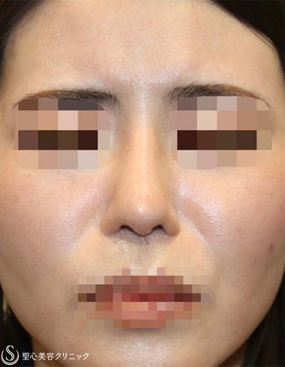 【30代女性・鼻柱の曲がりを修正】他院鼻修正：鼻中隔延長術（肋軟骨）＋鼻尖形成（耳介軟骨）＋鼻根プロテーゼ入替（術後４ヶ月） After 