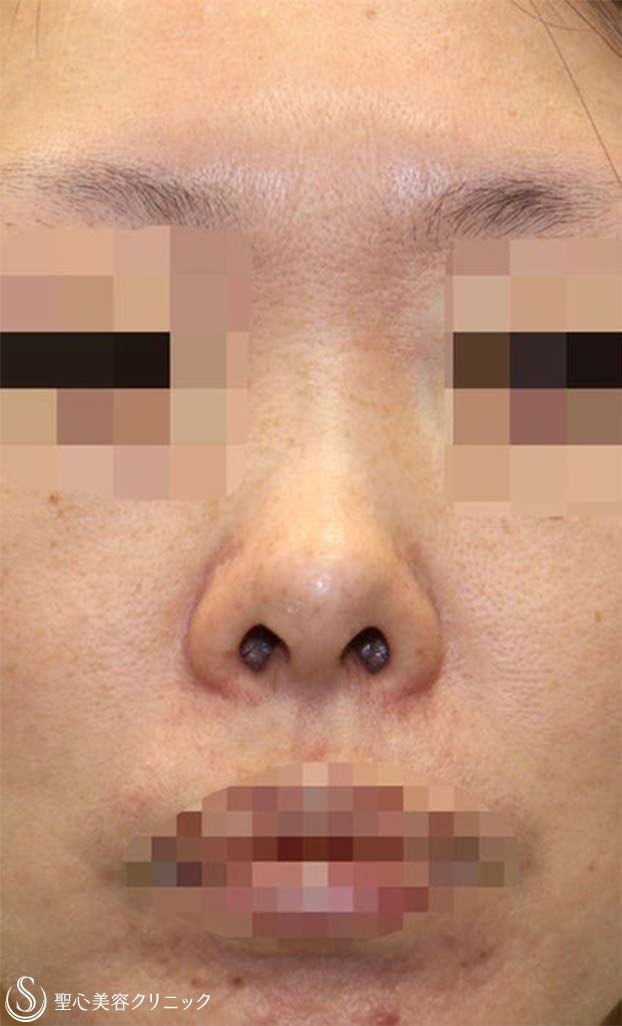 【40代女性・短鼻を改善し鼻先を綺麗に】鼻中隔延長術（肋軟骨）＋鼻尖形成（耳介軟骨・肋軟骨膜）＋鼻根プロテーゼ（術後１ヶ月） Before 