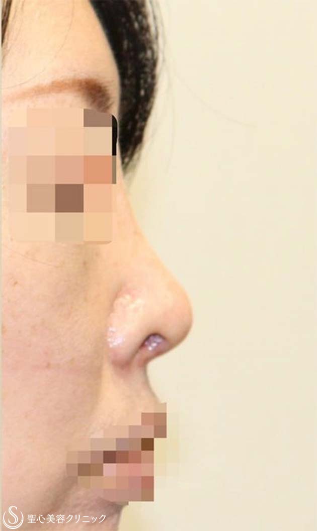 【40代女性・短鼻を改善し鼻先を綺麗に】鼻中隔延長術（肋軟骨）＋鼻尖形成（耳介軟骨・肋軟骨膜）＋鼻根プロテーゼ（術後１ヶ月） After 