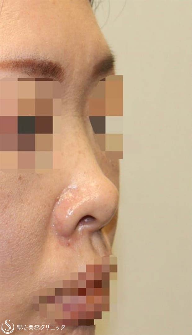 【40代女性・短鼻を改善し鼻先を綺麗に】鼻中隔延長術（肋軟骨）＋鼻尖形成（耳介軟骨・肋軟骨膜）＋鼻根プロテーゼ（術後１ヶ月） Before 