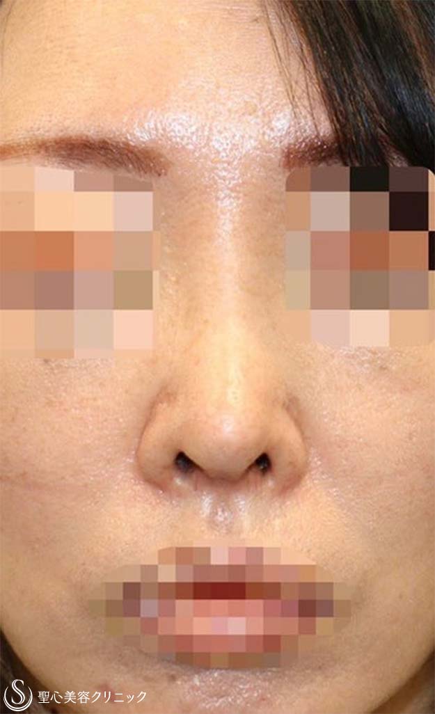 【40代女性・短鼻を改善し鼻先を綺麗に】鼻中隔延長術（肋軟骨）＋鼻尖形成（耳介軟骨・肋軟骨膜）＋鼻根プロテーゼ（術後１ヶ月） After 