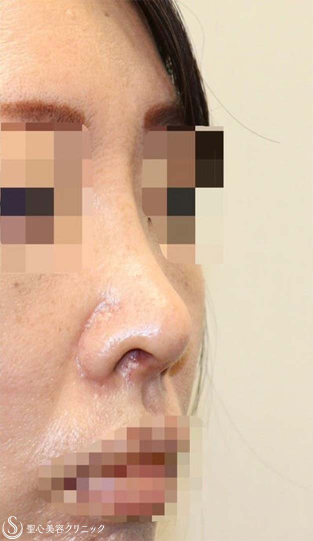 【40代女性・短鼻を改善し鼻先を綺麗に】鼻中隔延長術（肋軟骨）＋鼻尖形成（耳介軟骨・肋軟骨膜）＋鼻根プロテーゼ（術後１ヶ月） After 