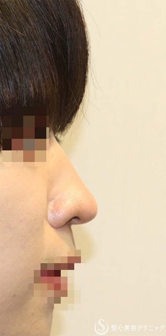【20代男性・斜鼻、鼻先の下垂を改善し、鼻を高く】鼻尖縮小＋鼻尖形成(耳介軟骨移植)＋鼻背形成（肋軟骨）（術後1週間） Before 