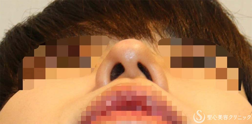 【20代男性・斜鼻、鼻先の下垂を改善し、鼻を高く】鼻尖縮小＋鼻尖形成(耳介軟骨移植)＋鼻背形成（肋軟骨）（術後1週間） Before 