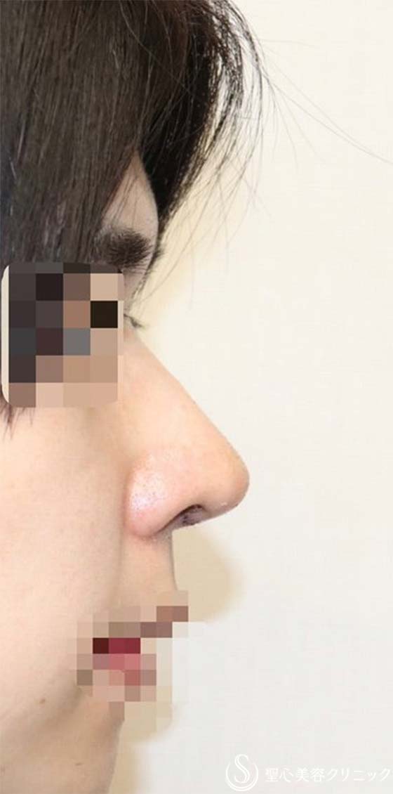【20代男性・斜鼻、鼻先の下垂を改善し、鼻を高く】鼻尖縮小＋鼻尖形成(耳介軟骨移植)＋鼻背形成（肋軟骨）（術後1週間） After 