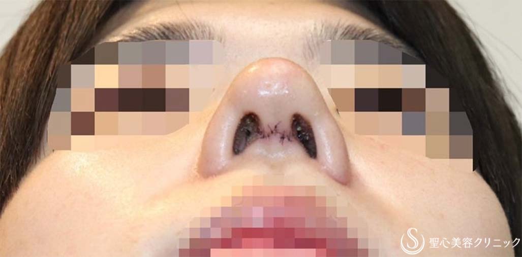 【20代男性・斜鼻、鼻先の下垂を改善し、鼻を高く】鼻尖縮小＋鼻尖形成(耳介軟骨移植)＋鼻背形成（肋軟骨）（術後1週間） After 