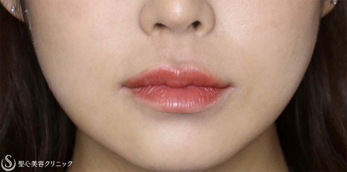 【20代女性・人中をできるだけ短くしたい！！】プレミアムリップリフト（プレミアム人中短縮術）（術後1ヶ月） Before 