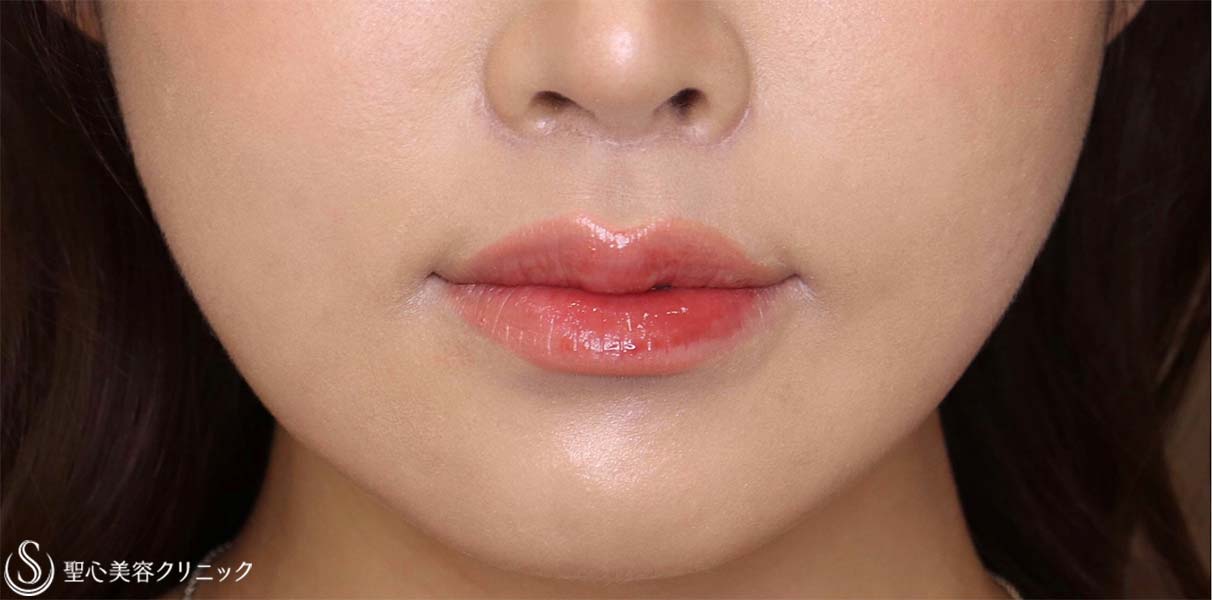 【20代女性・人中をできるだけ短くしたい！！】プレミアムリップリフト（プレミアム人中短縮術）（術後1ヶ月） After 