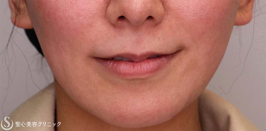 【30代女性・人中をできるだけ短くしたい！！】プレミアムリップリフト（プレミアム人中短縮術）（術後1ヶ月） Before 