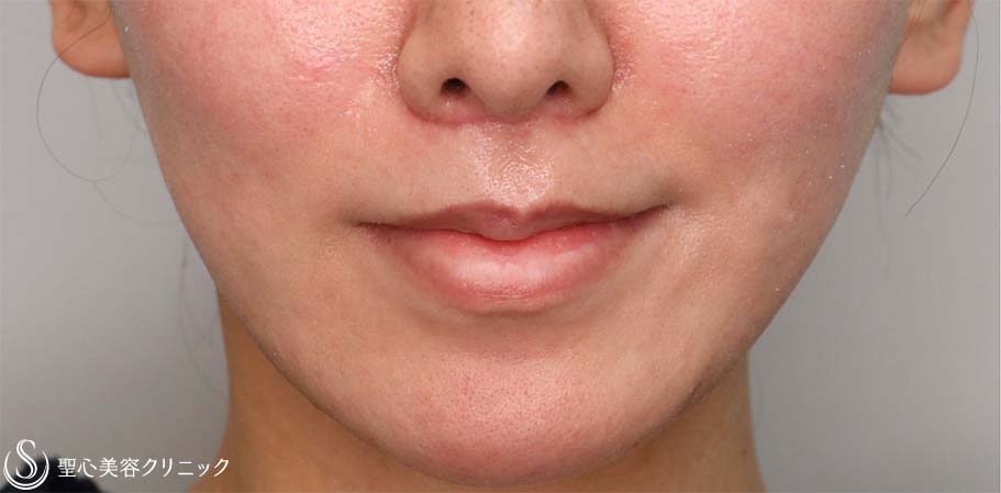【30代女性・人中をできるだけ短くしたい！！】プレミアムリップリフト（プレミアム人中短縮術）（術後1ヶ月） After 