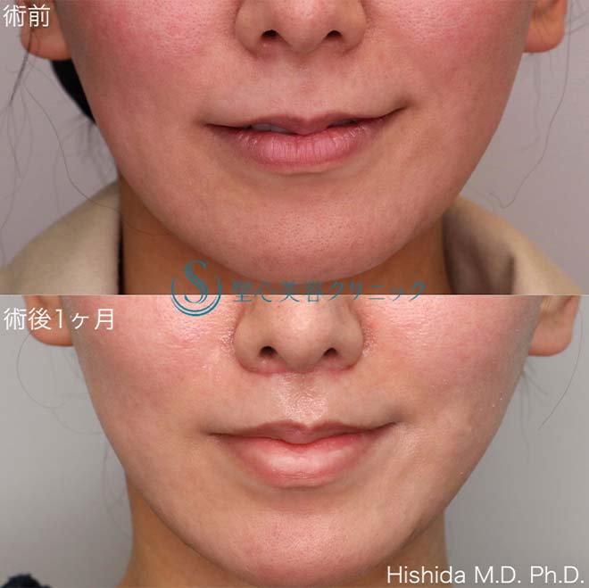 【30代女性・人中をできるだけ短くしたい！！】プレミアムリップリフト（プレミアム人中短縮術）（術後1ヶ月） After 
