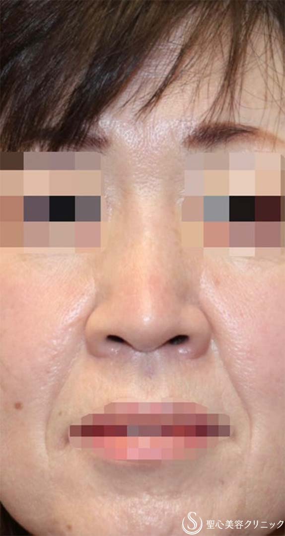 【40代女性・厚いお鼻をスッキリ・鼻の穴も目立たなく】鼻中隔延長術（肋軟骨）＋鼻尖形成（肋軟骨）＋鼻背形成（肋軟骨）（術後6ヶ月） After 