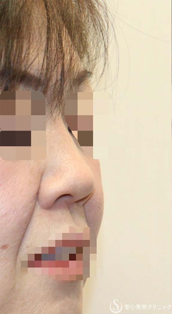 【40代女性・厚いお鼻をスッキリ・鼻の穴も目立たなく】鼻中隔延長術（肋軟骨）＋鼻尖形成（肋軟骨）＋鼻背形成（肋軟骨）（術後6ヶ月） Before 