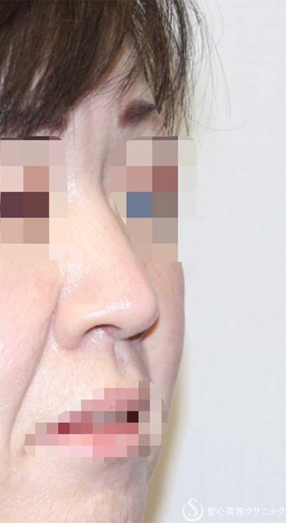 【40代女性・厚いお鼻をスッキリ・鼻の穴も目立たなく】鼻中隔延長術（肋軟骨）＋鼻尖形成（肋軟骨）＋鼻背形成（肋軟骨）（術後6ヶ月） After 