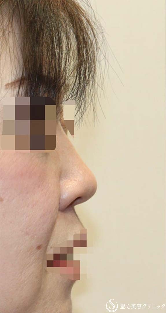 【40代女性・厚いお鼻をスッキリ・鼻の穴も目立たなく】鼻中隔延長術（肋軟骨）＋鼻尖形成（肋軟骨）＋鼻背形成（肋軟骨）（術後6ヶ月） Before 