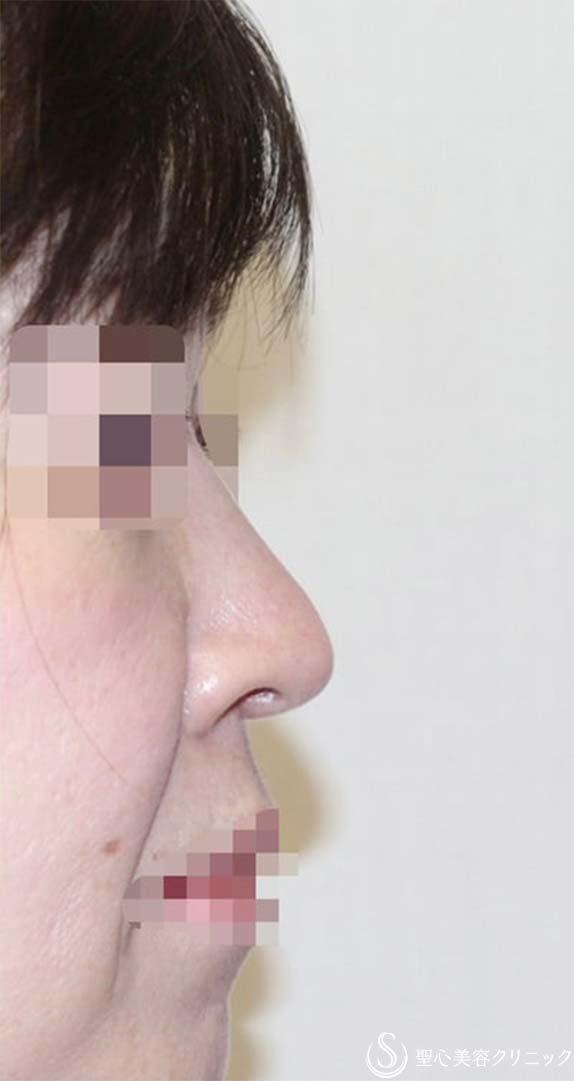 【40代女性・厚いお鼻をスッキリ・鼻の穴も目立たなく】鼻中隔延長術（肋軟骨）＋鼻尖形成（肋軟骨）＋鼻背形成（肋軟骨）（術後6ヶ月） After 