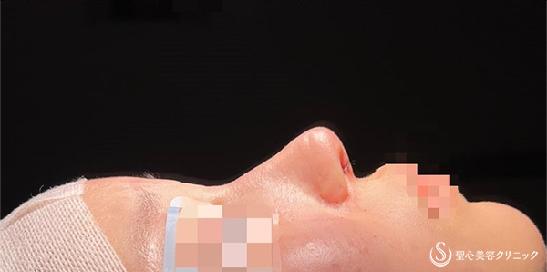 【20代女性・ポリービーク変形・アップノーズを改善し美人鼻に】鼻中隔延長術（肋軟骨）＋鼻尖形成（肋軟骨）＋プロテーゼ入替（術後1週間) After 