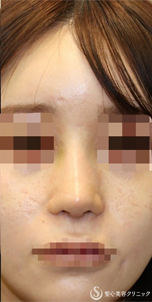 【20代女性・ポリービーク変形・アップノーズを改善し美人鼻に】鼻中隔延長術（肋軟骨）＋鼻尖形成（肋軟骨）＋プロテーゼ入替（術後1週間) After 